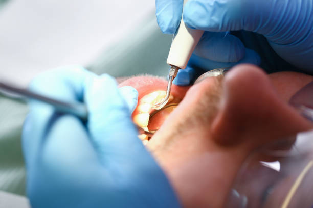 Best Emergency Treatment for Dental Infections or Abscesses in Pontotoc, MS